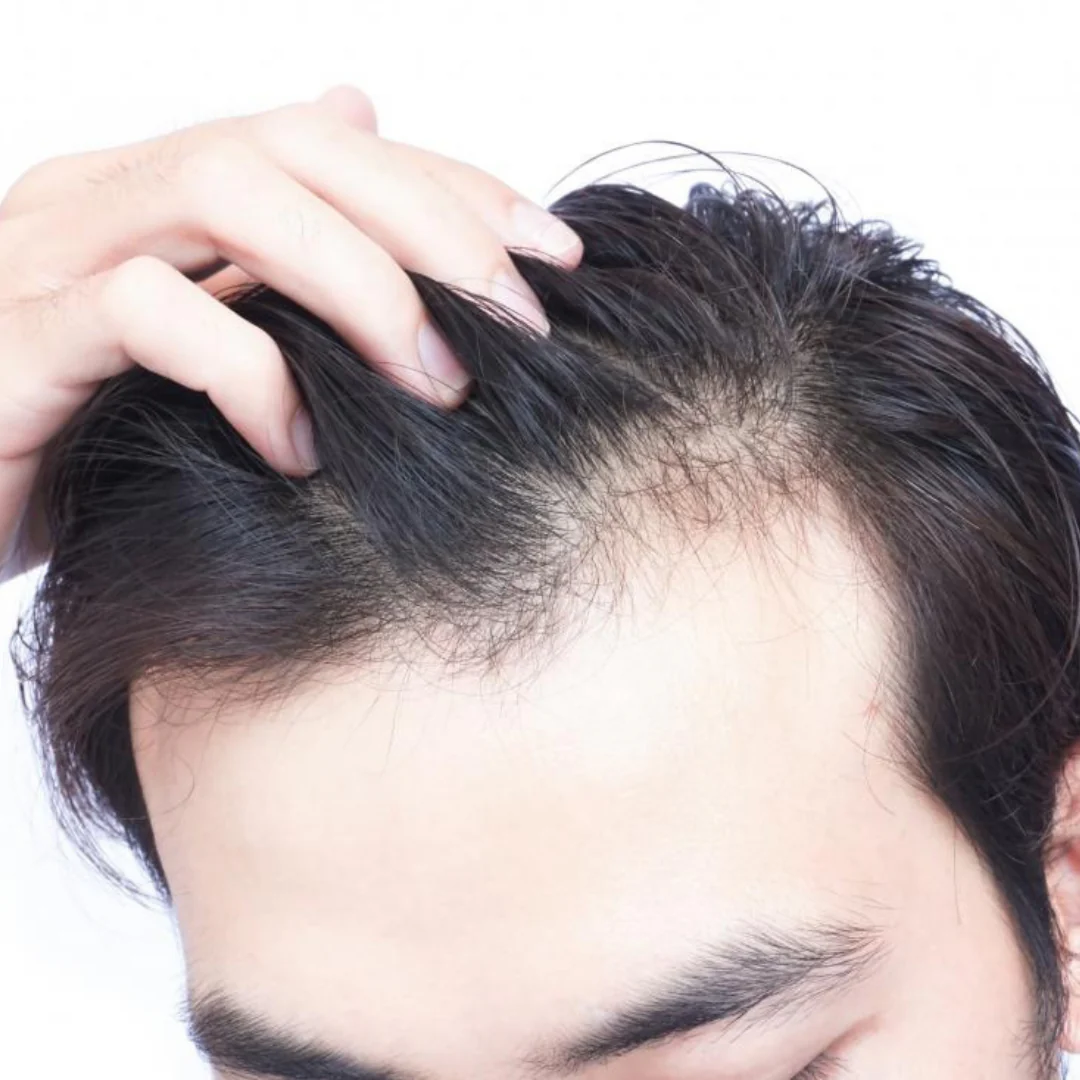 Hair Loss Treatment in Islamabad: Restore Your Confidence