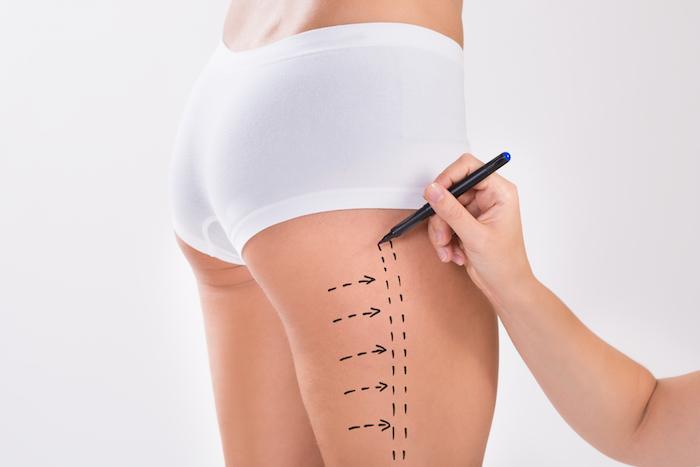 The Most Common Liposuction Incision Types