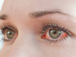 What’s causing your itching, teary eyes?