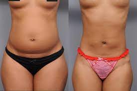 CoolSculpting Before and After: What to Expect