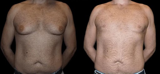 How to Choose the Right Male Breast Reduction for Your Skin Type